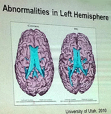 Temple Grandin's Left Hemisphere